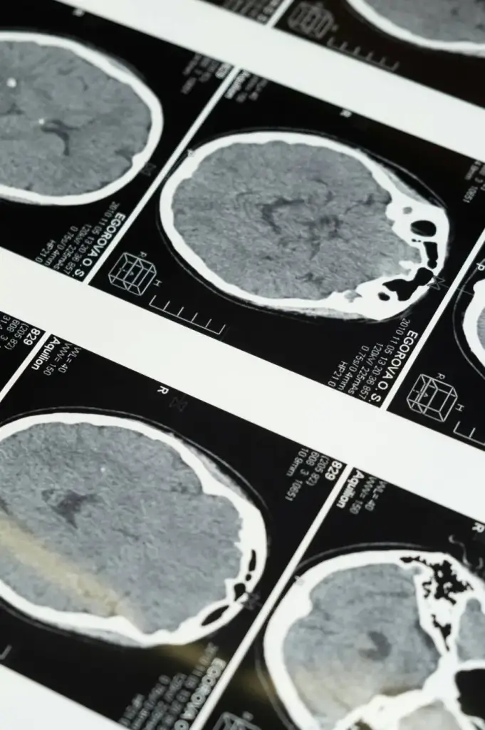 neurorrehabilitacion